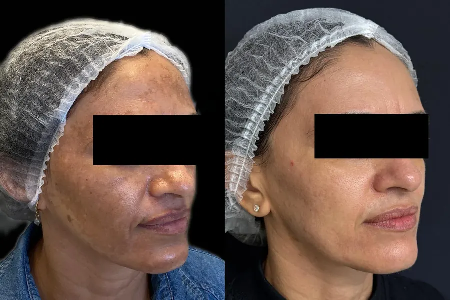 Antes e depois — tratamento de manchas com Luz Pulsada