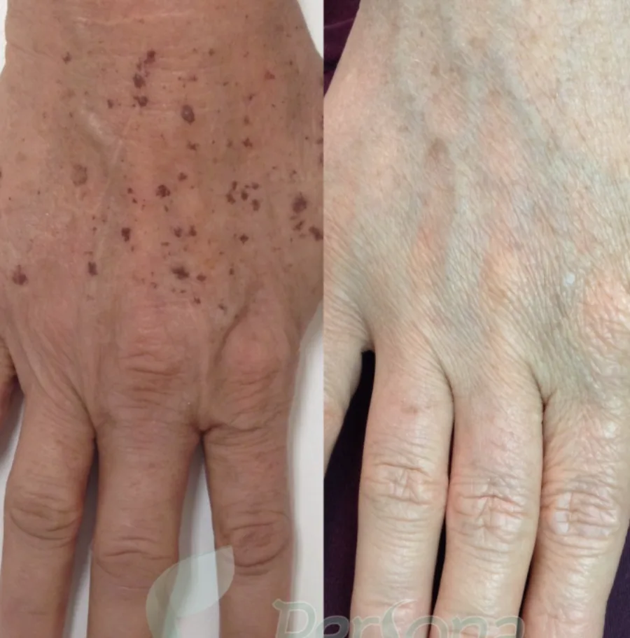 Antes e depois — paciente Persona Dermatologia