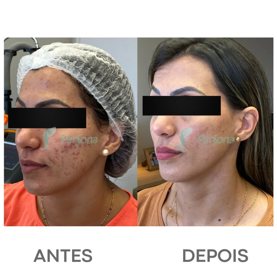 Antes e depois — paciente Persona Dermatologia