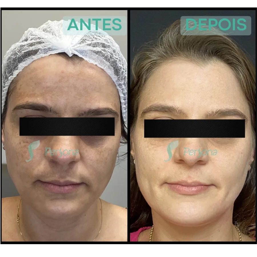 Antes e depois — paciente Persona Dermatologia